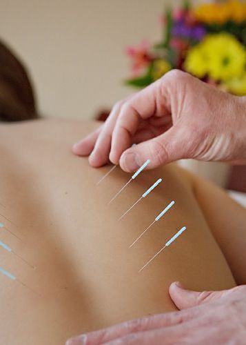 Acupuncture & Acupressure